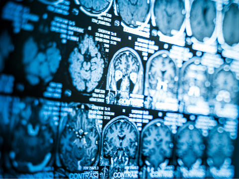 Bildschirmausschnitt mit mehreren CT-Aufnahmen eines Gehirns