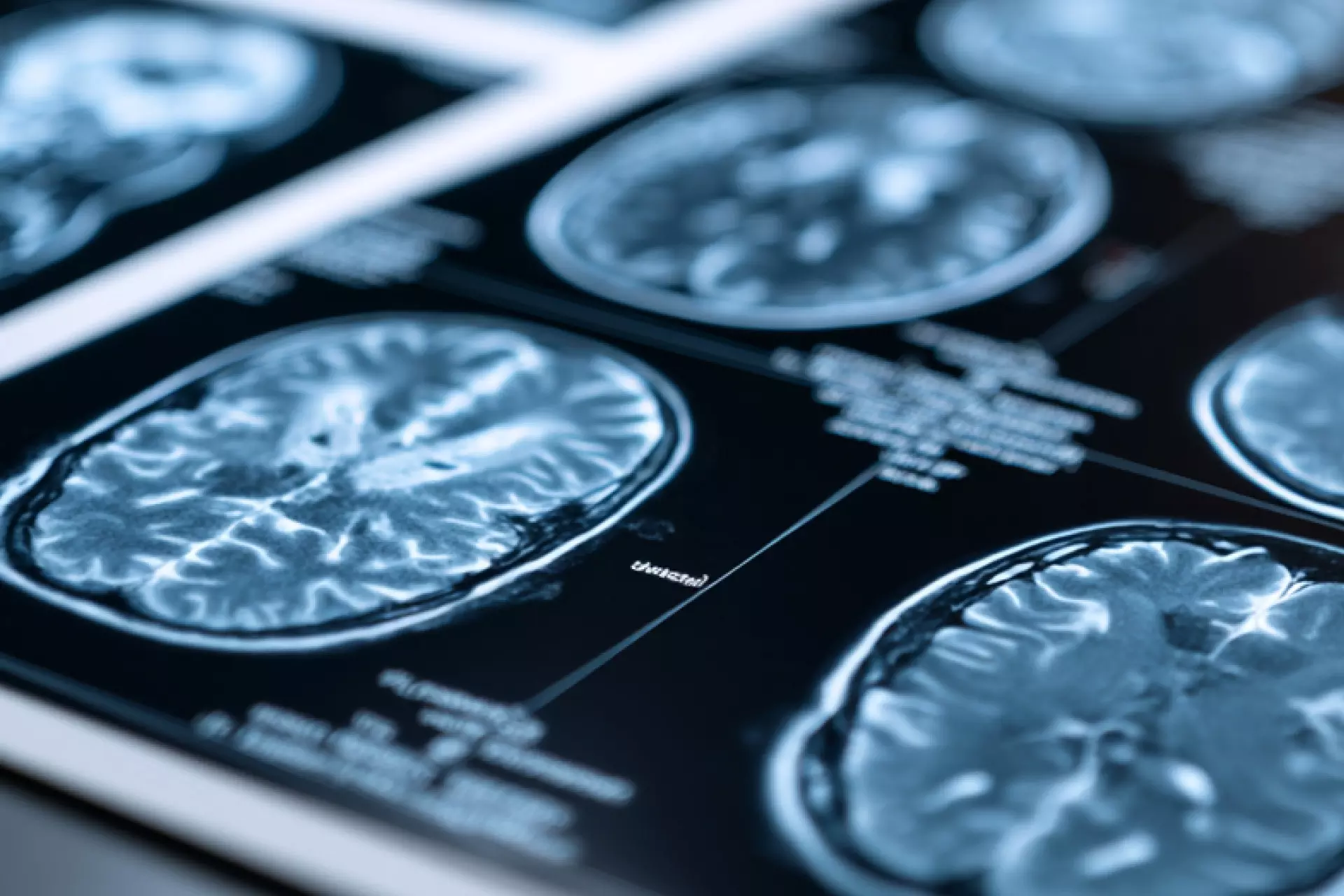 Gehirnscan: Medizinische Bildgebung zur Analyse von Gedächtnisleistungen